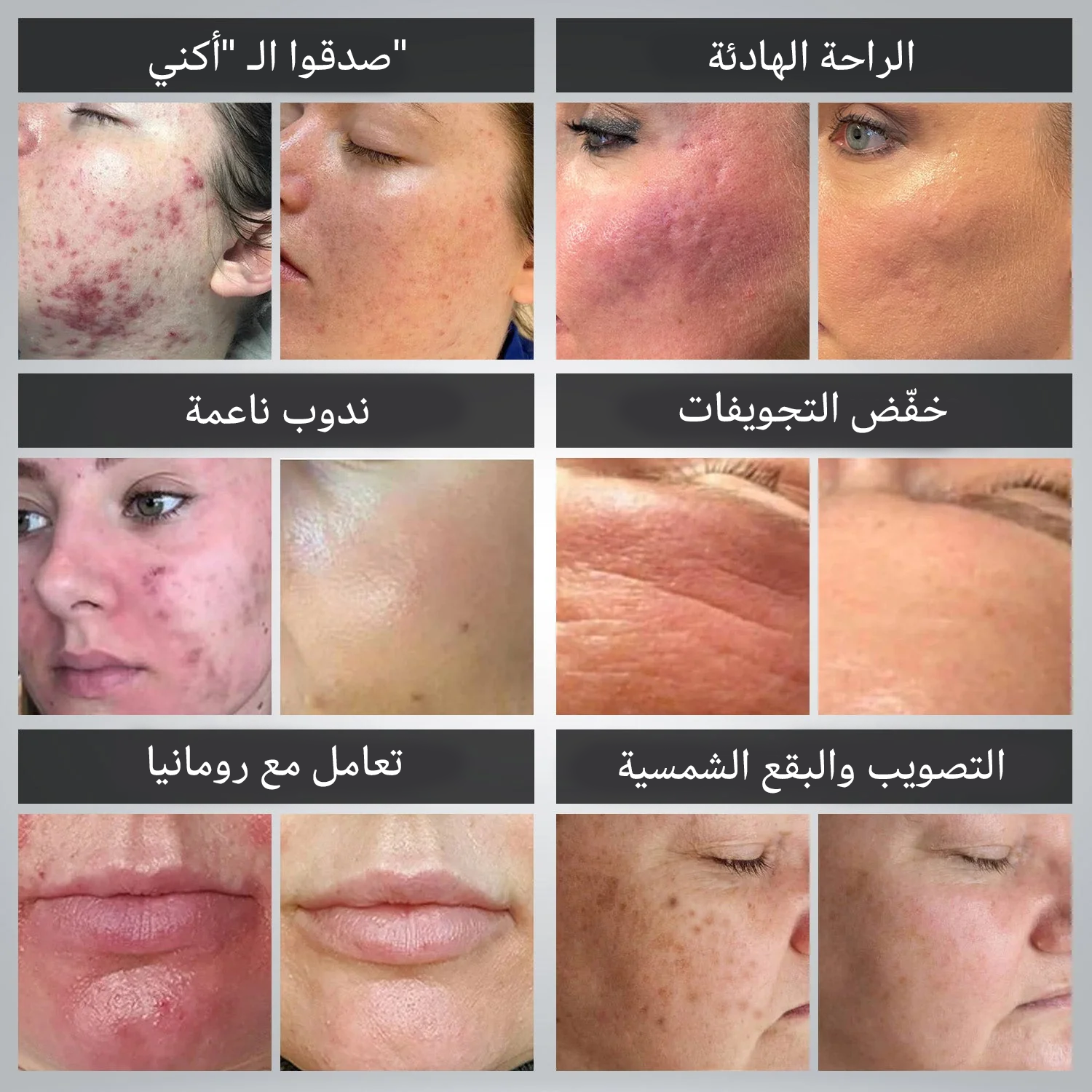 جهاز العلاج الضوئي Megelin بتقنية LED